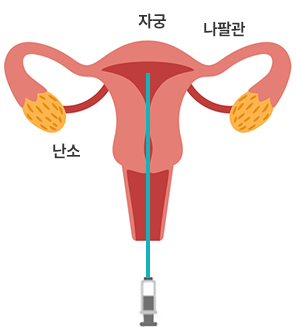 자궁, 난소, 나팔관의 위치와 정자 부입 부분 이미지
