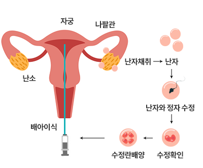 자궁, 난소, 나팔관의 위치 / 난차채취 → 난자 → 난자와 정자 수정 → 수정확인 → 수정란배양 → 배아이식
